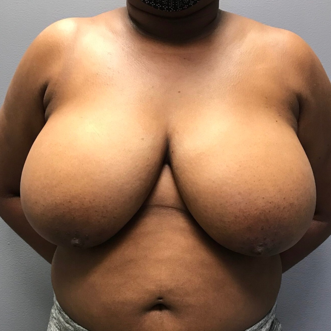 Breast-Reduction-Patient-8 | Before Breast Reduction