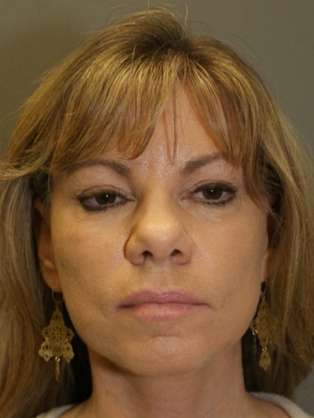 Facelift-Patient-3 | After Facelift