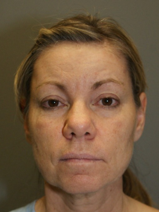 Facelift-Patient-3 | Before Facelift