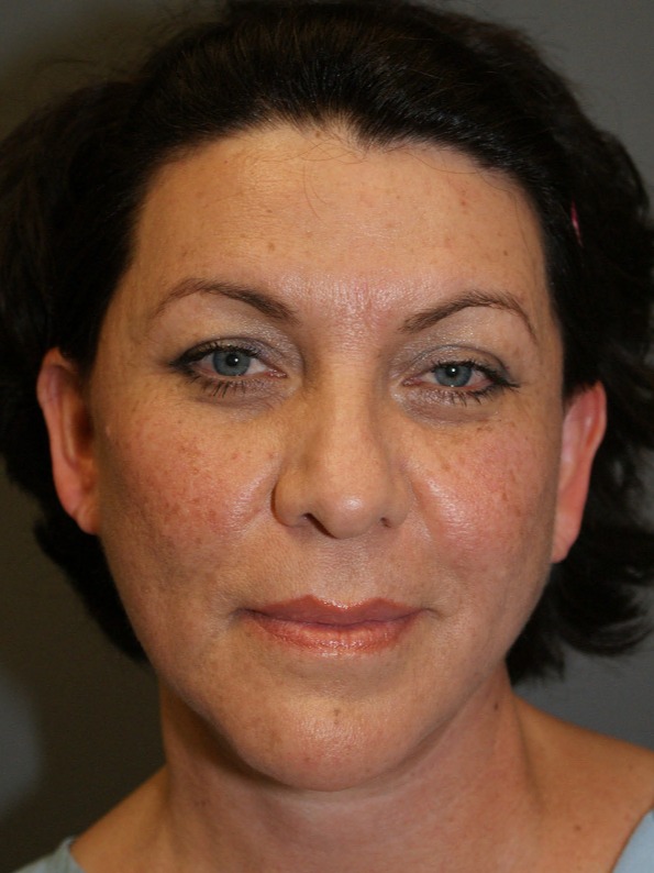 Facelift-Patient-4 | After Facelift