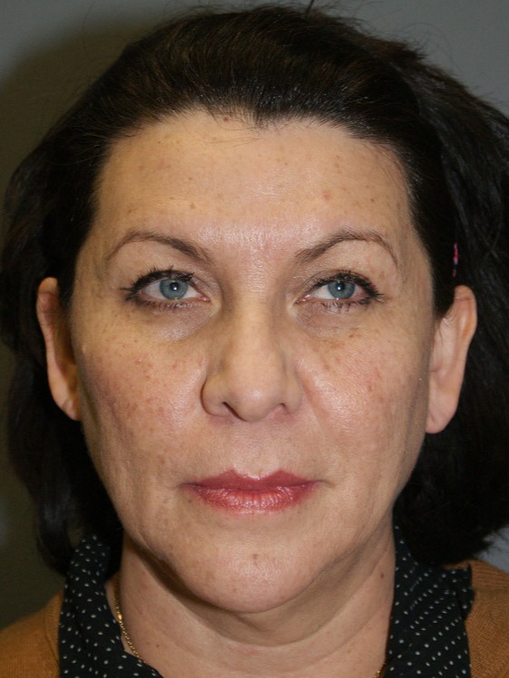 Facelift-Patient-4 | Before Facelift