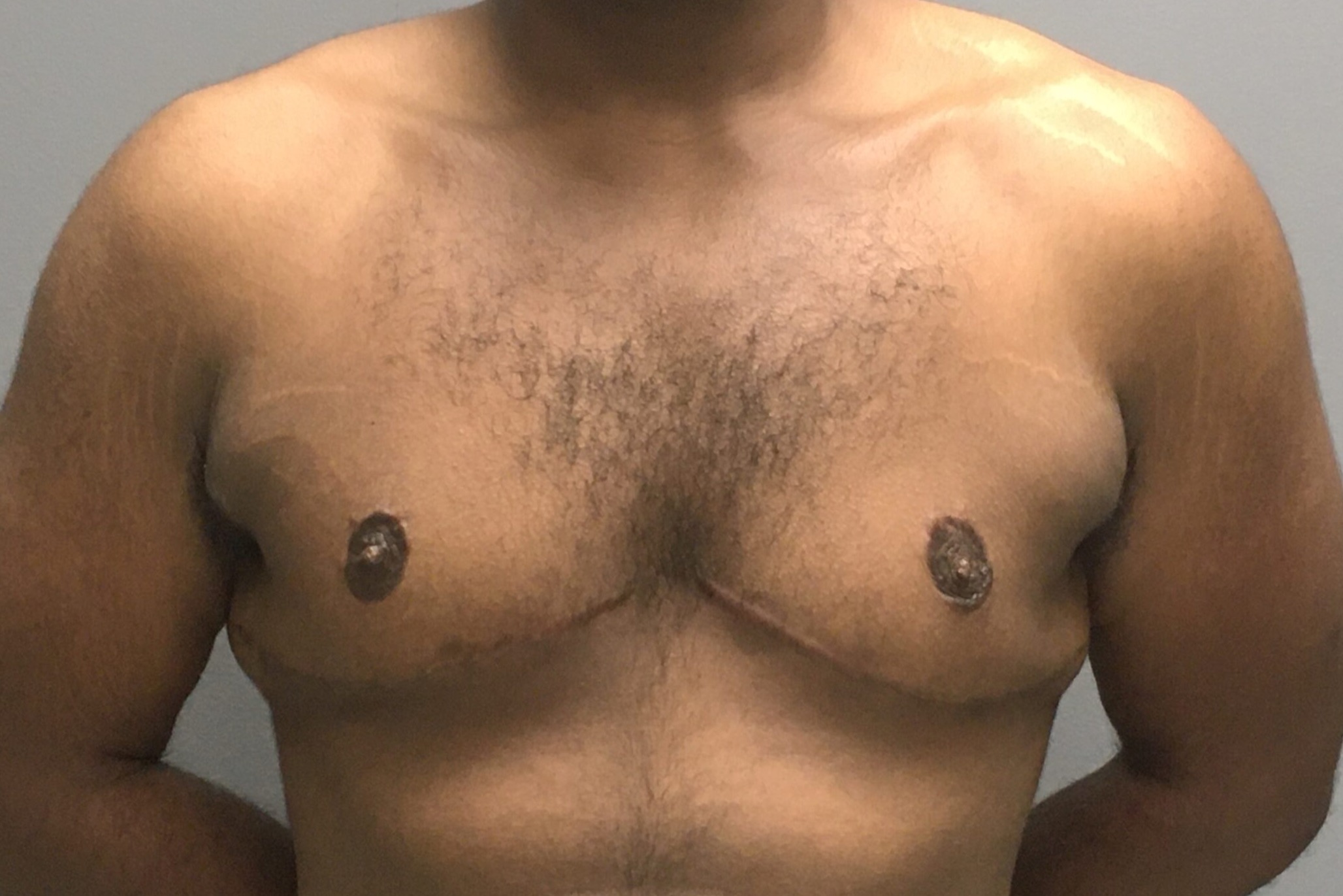 Gynecomastia-Patient-4 | After Gynecomastia