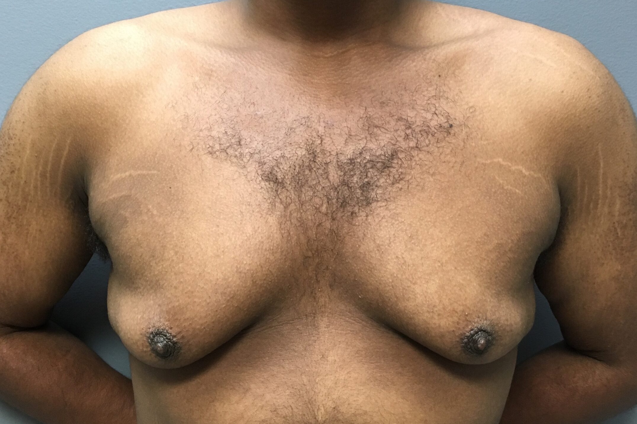 Gynecomastia-Patient-4 | Before Gynecomastia