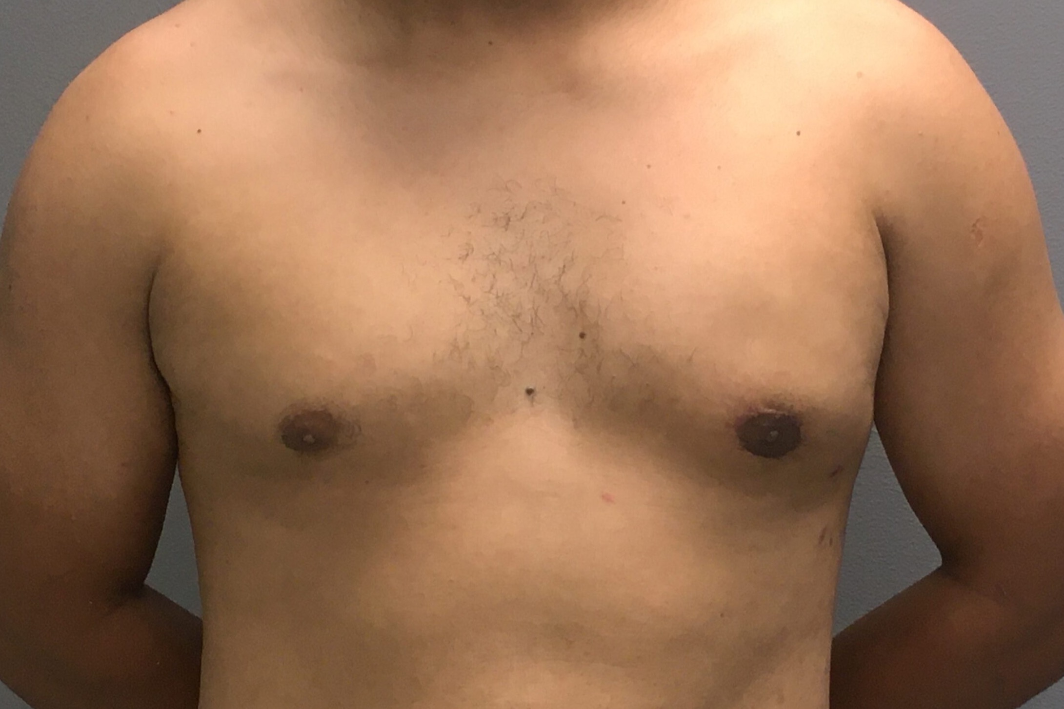 Gynecomastia-Patient-3 | After Gynecomastia