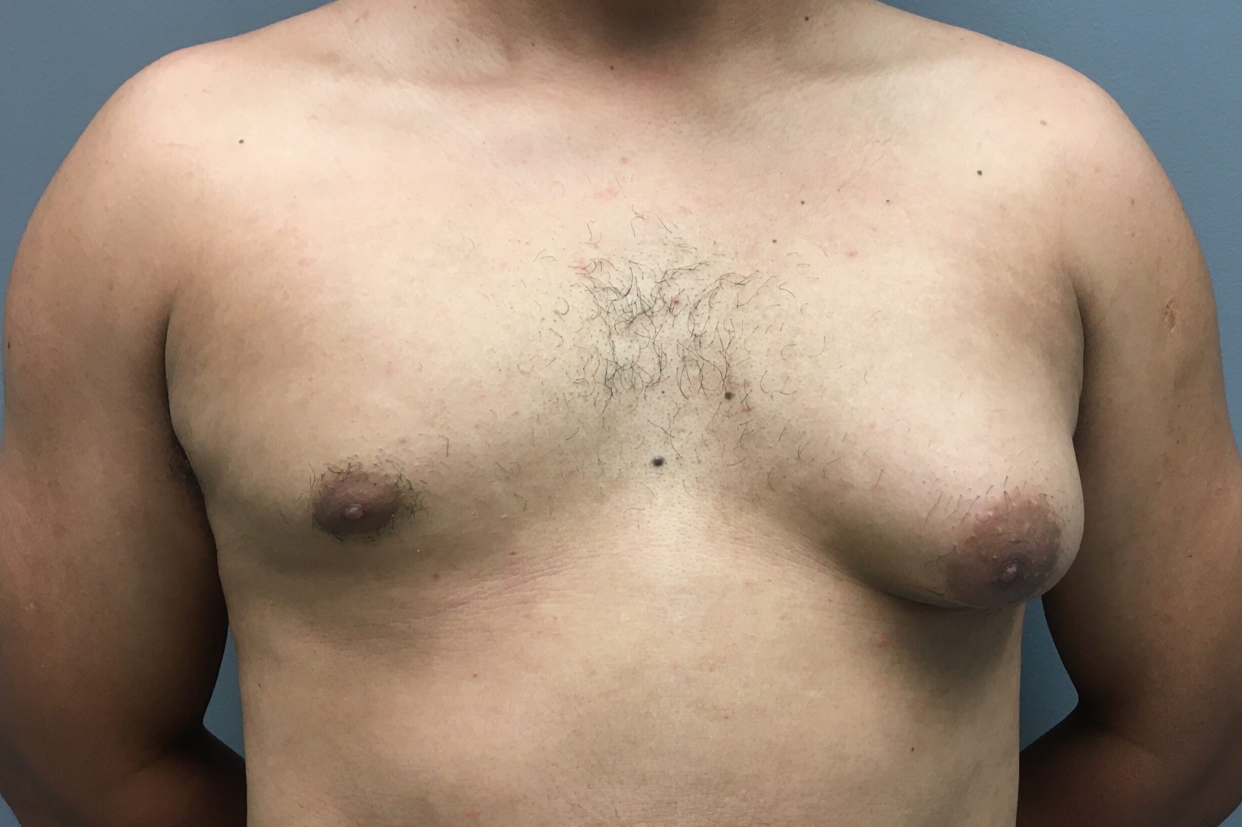 Gynecomastia-Patient-3 | Before Gynecomastia
