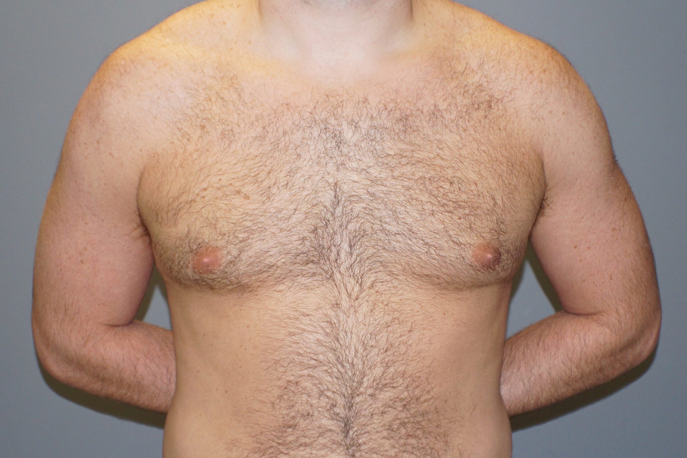 Gynecomastia-Patient-7 | After Gynecomastia