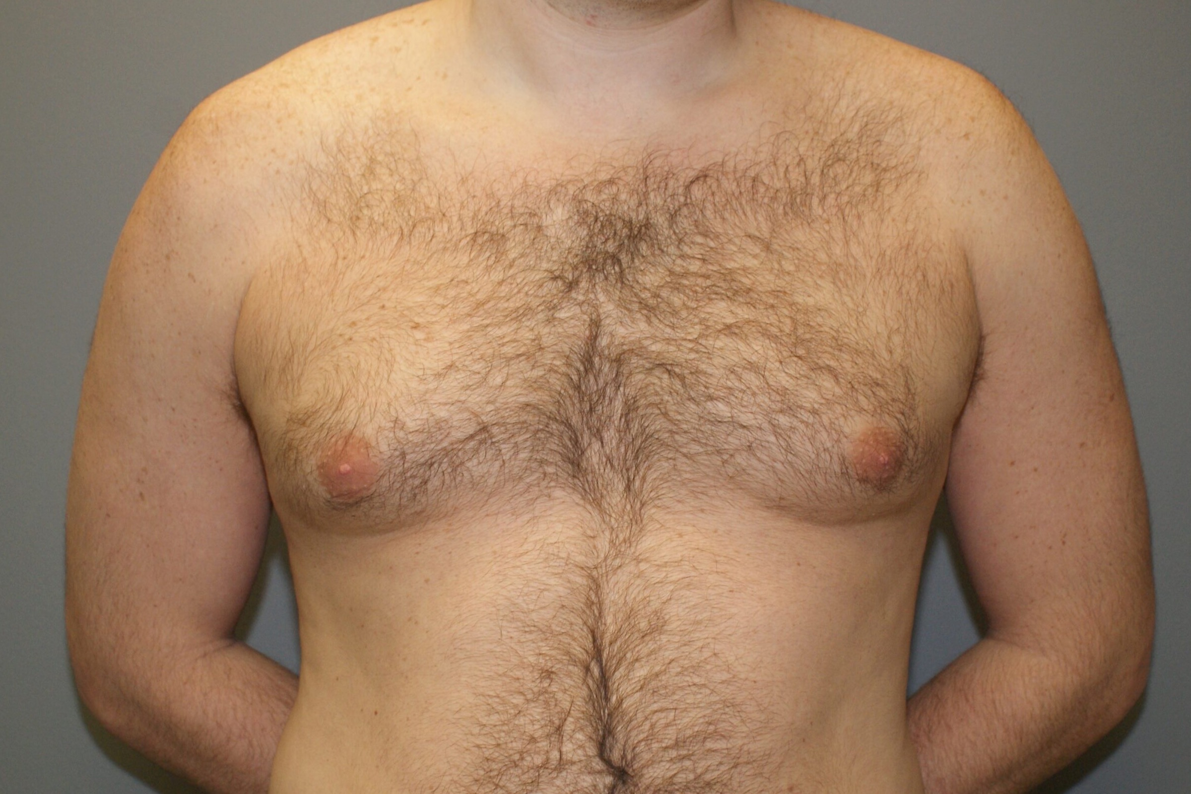 Gynecomastia-Patient-7 | Before Gynecomastia