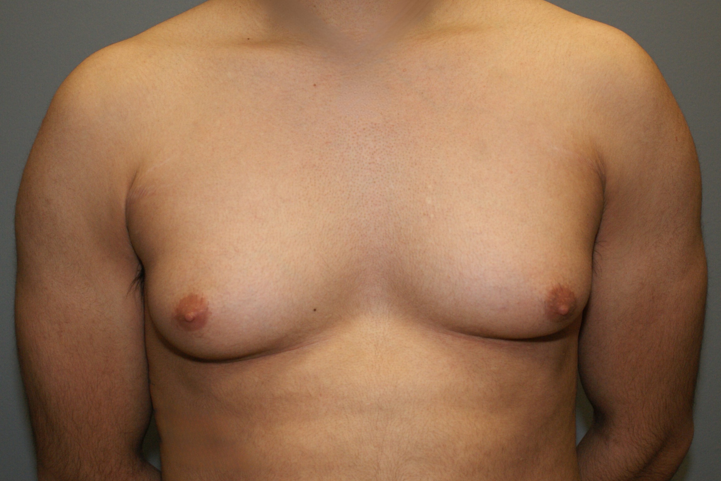 Gynecomastia-Patient-6 | Before Gynecomastia