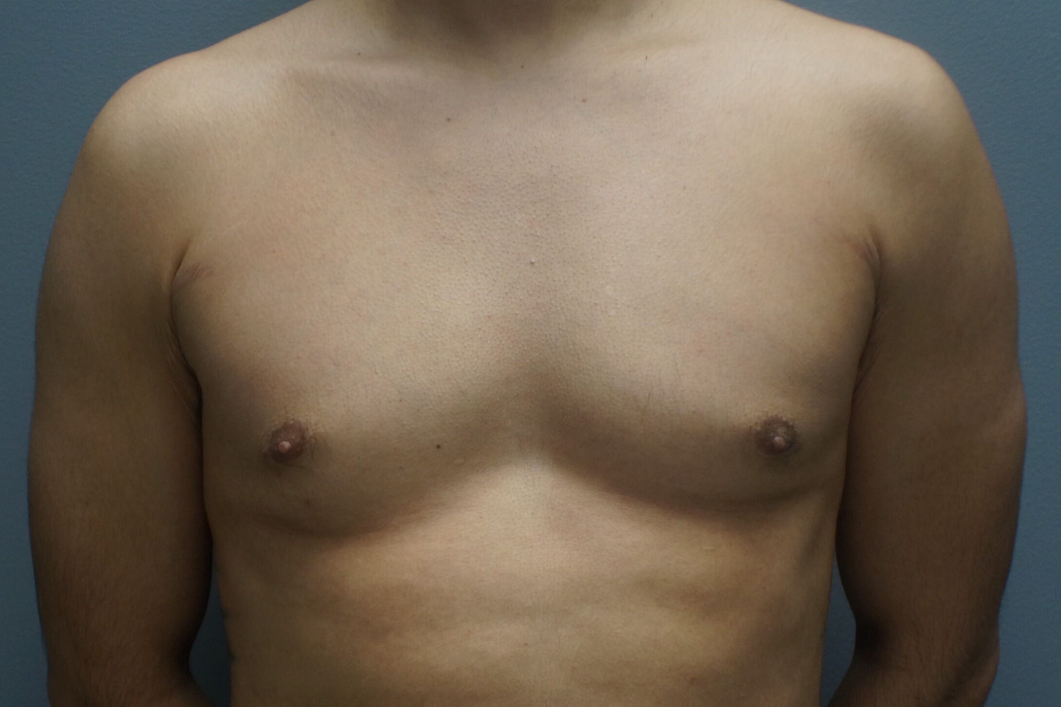 Gynecomastia-Patient-6 | After Gynecomastia