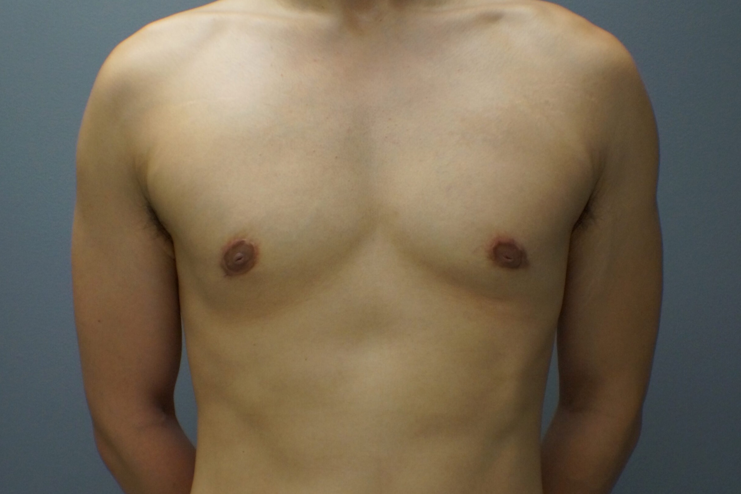 Gynecomastia-Patient-5 | After Gynecomastia