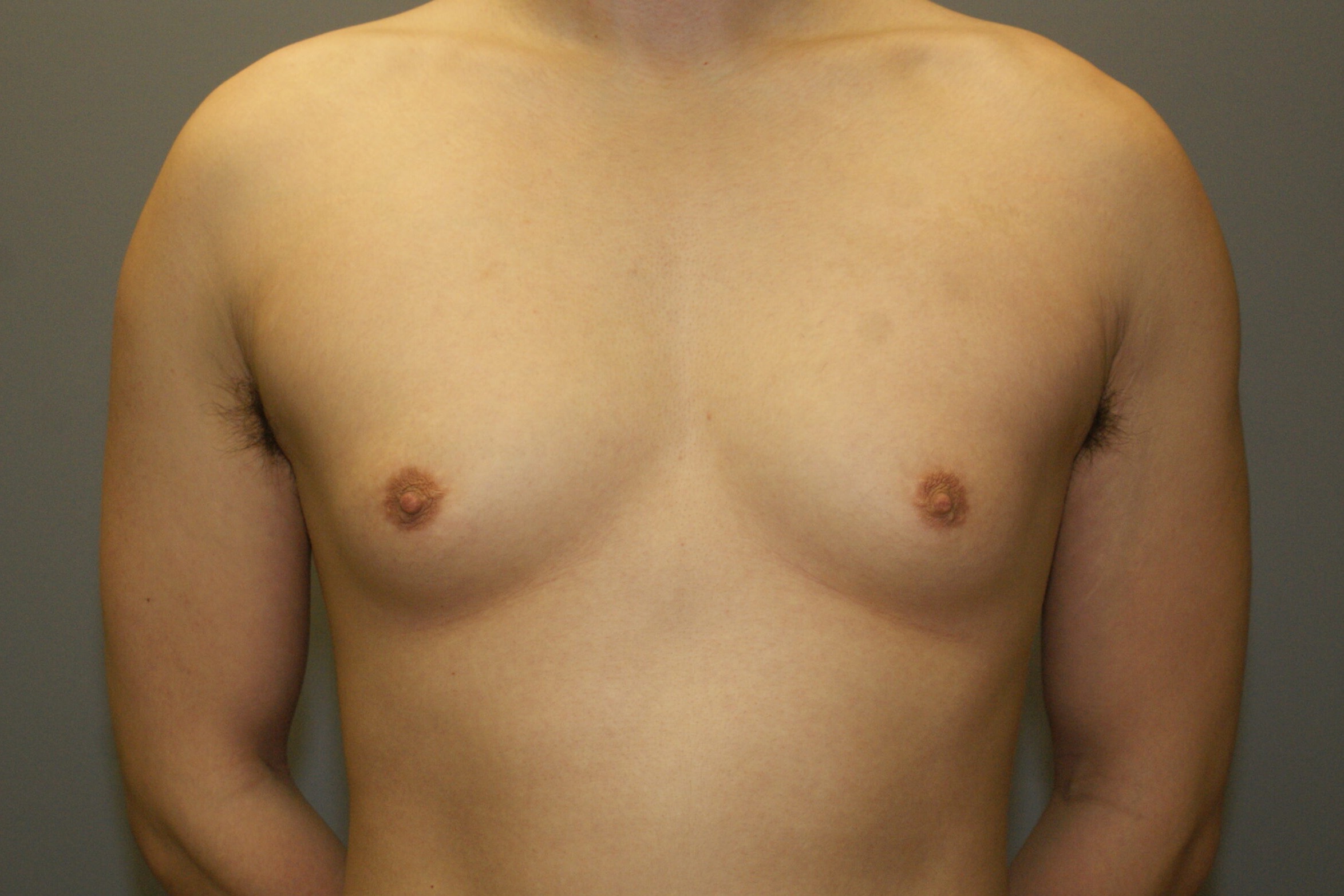 Gynecomastia-Patient-5 | Before Gynecomastia