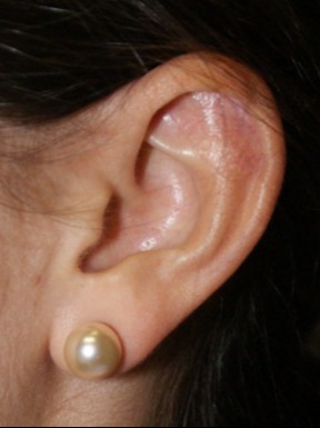 Keloid-Scar-Removal-Patient-3 | After Keloid Scar Removal