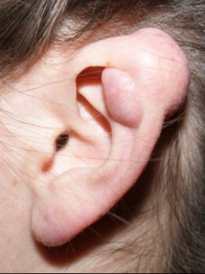 Keloid-Scar-Removal-Patient-3 | Before Keloid Scar Removal