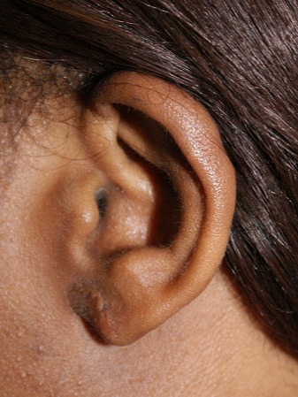 Keloid-Scar-Removal-Patient-4 | After Keloid Scar Removal