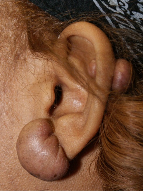 Keloid-Scar-Removal-Patient-4 | Before Keloid Scar Removal