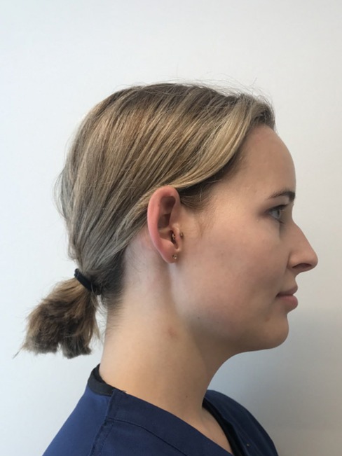 Kybella-Patient-2 | After Non Surgical