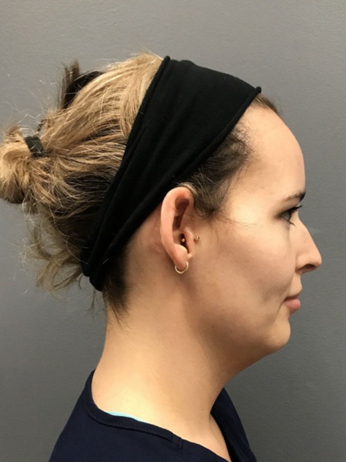 Kybella-Patient-2 | Before Non Surgical