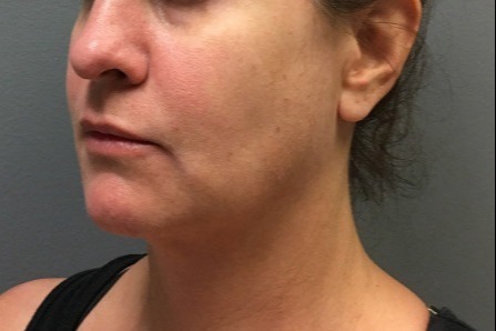 Kybella-Patient-1 | After Non Surgical