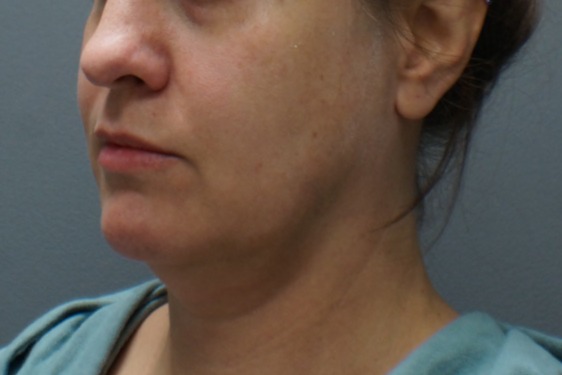 Kybella-Patient-1 | Before Non Surgical