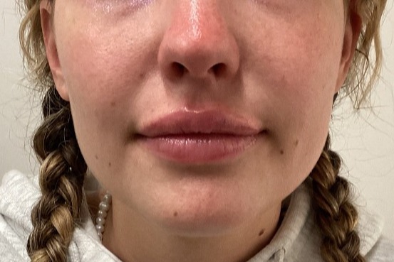 Patient-2 | After Lip Augmentation