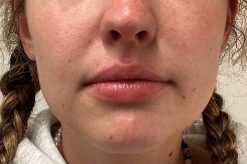 Patient-2 | Before Lip Augmentation