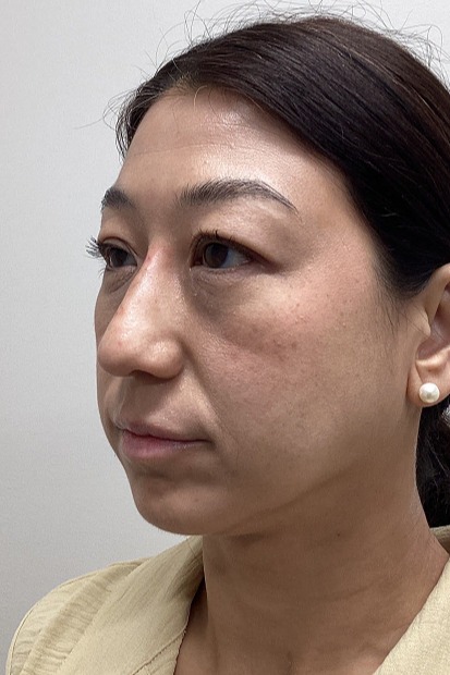 Liquid-Rhinoplasty-Patient-1 | After Non Surgical