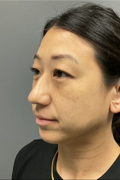 Liquid-Rhinoplasty-Patient-1 | Before Non Surgical