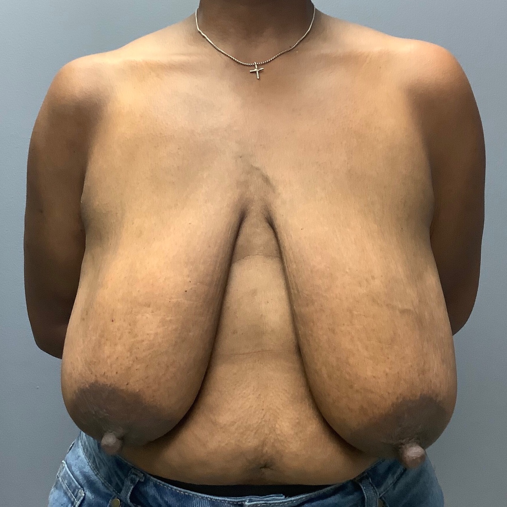 Breast-Lift-Patient-8 | Before Breast Lift