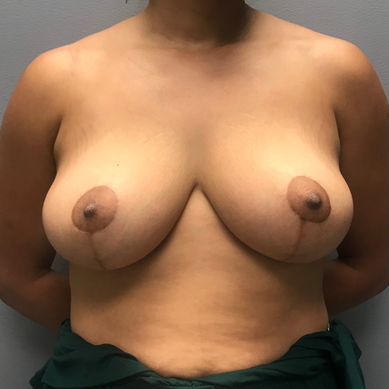 Breast-Lift-Patient-9 | After Breast Lift