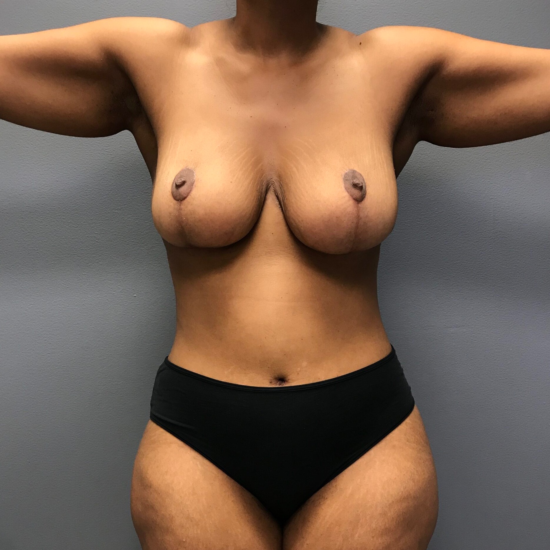 Mommy-Makeover-Patient-3 | After Abdominoplasty