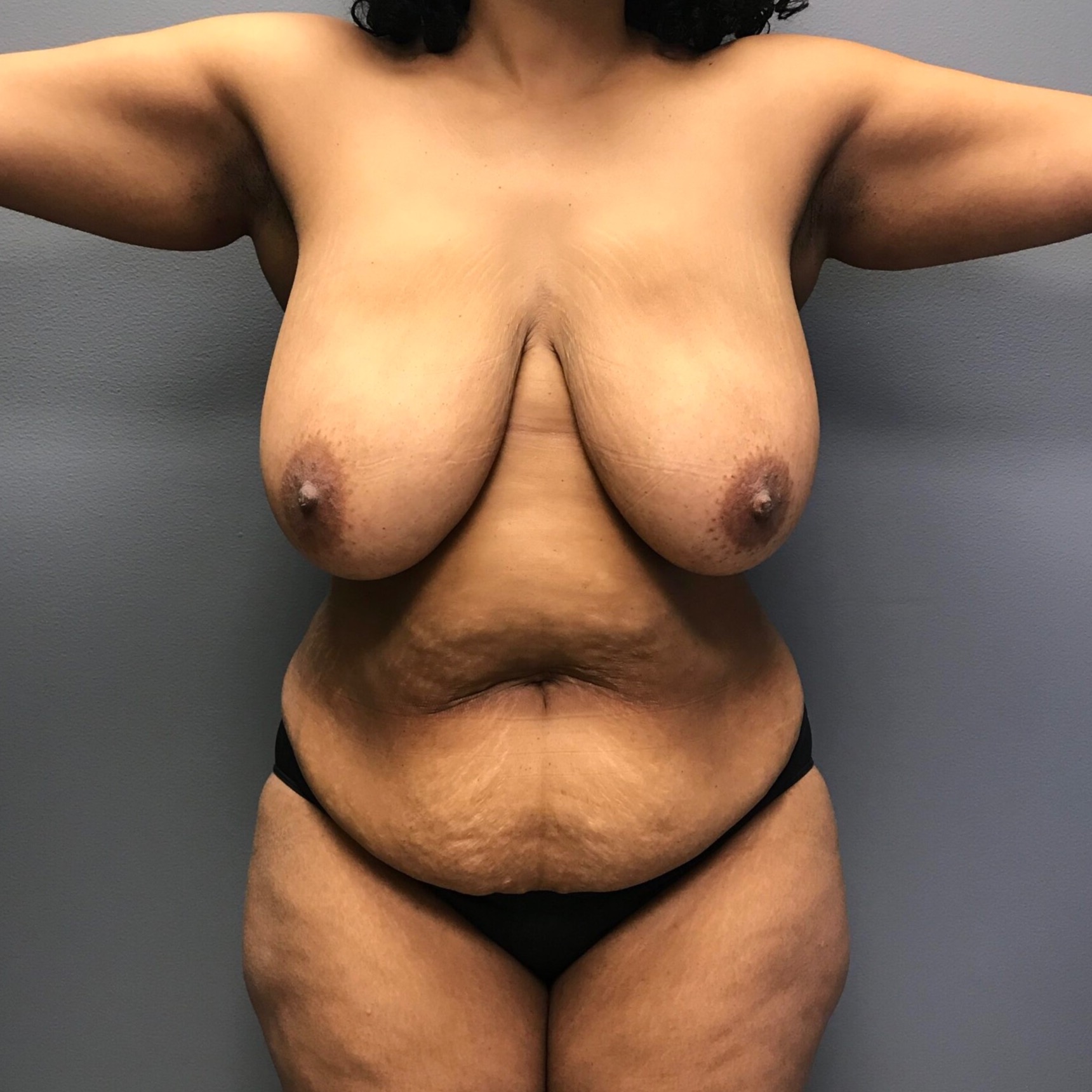 Mommy-Makeover-Patient-3 | Before Abdominoplasty