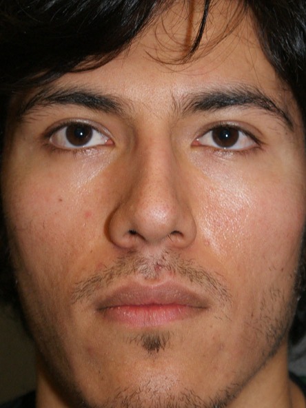 Rhinoplasty-Patient-3 | Before Rhinoplasty