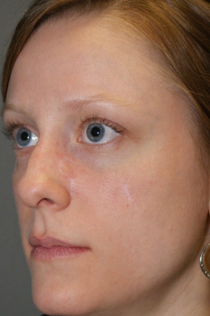 Skin-Cancer-Patient-3 | After Skin Cancer Repair