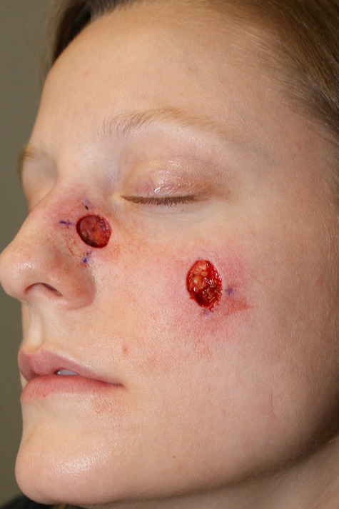 Skin-Cancer-Patient-3 | Before Skin Cancer Repair
