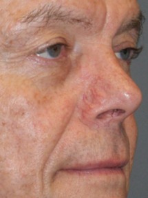 Skin-Cancer-Patient-6 | After Skin Cancer Repair