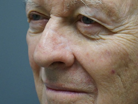 Skin-Cancer-Patient-4 | After Skin Cancer Repair