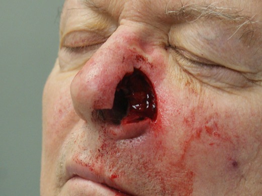 Skin-Cancer-Patient-4 | Before Skin Cancer Repair