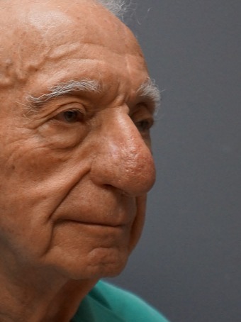 Skin-Cancer-Patient-5 | After Skin Cancer Repair