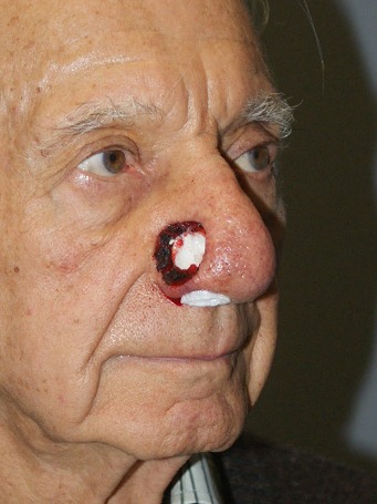 Skin-Cancer-Patient-5 | Before Skin Cancer Repair
