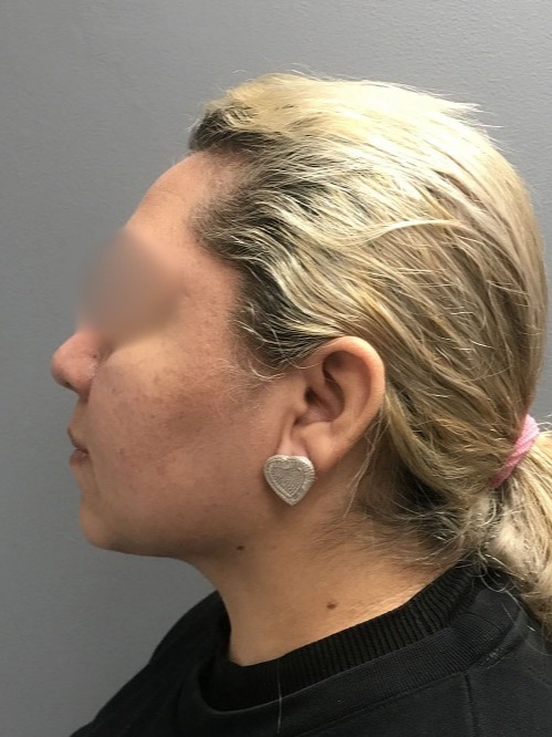 Submental-Liposuction-Patient-5 | After Liposuction