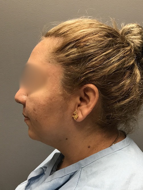 Submental-Liposuction-Patient-5 | Before Liposuction