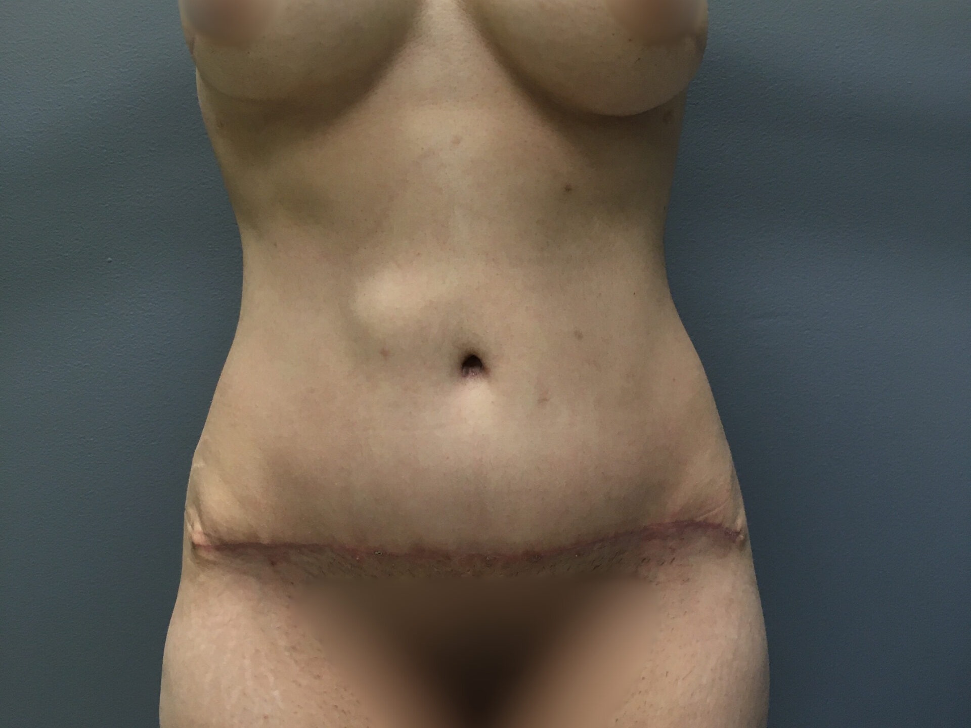 Abdominoplasty-Patient-12 | After Abdominoplasty