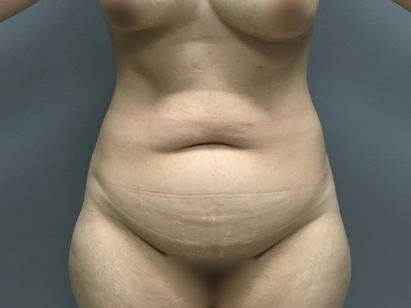 Abdominoplasty-Patient-12 | Before Abdominoplasty