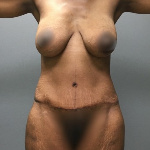 Abdominoplasty-Patient-10 | After Abdominoplasty