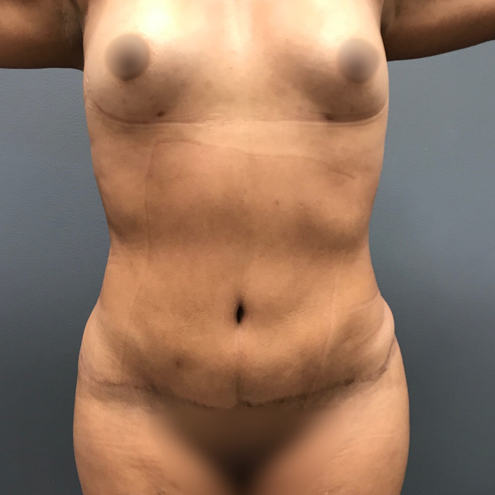 Abdominoplasty-Patient-9 | After Abdominoplasty