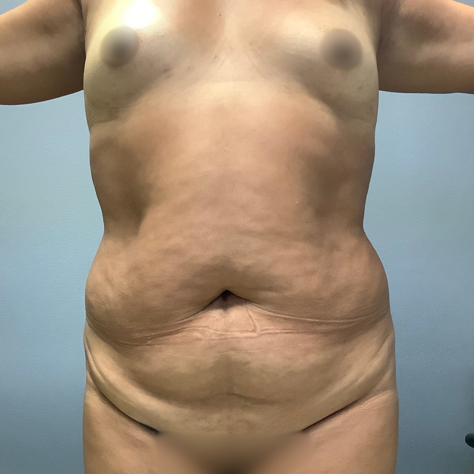 Abdominoplasty-Patient-9 | Before Abdominoplasty