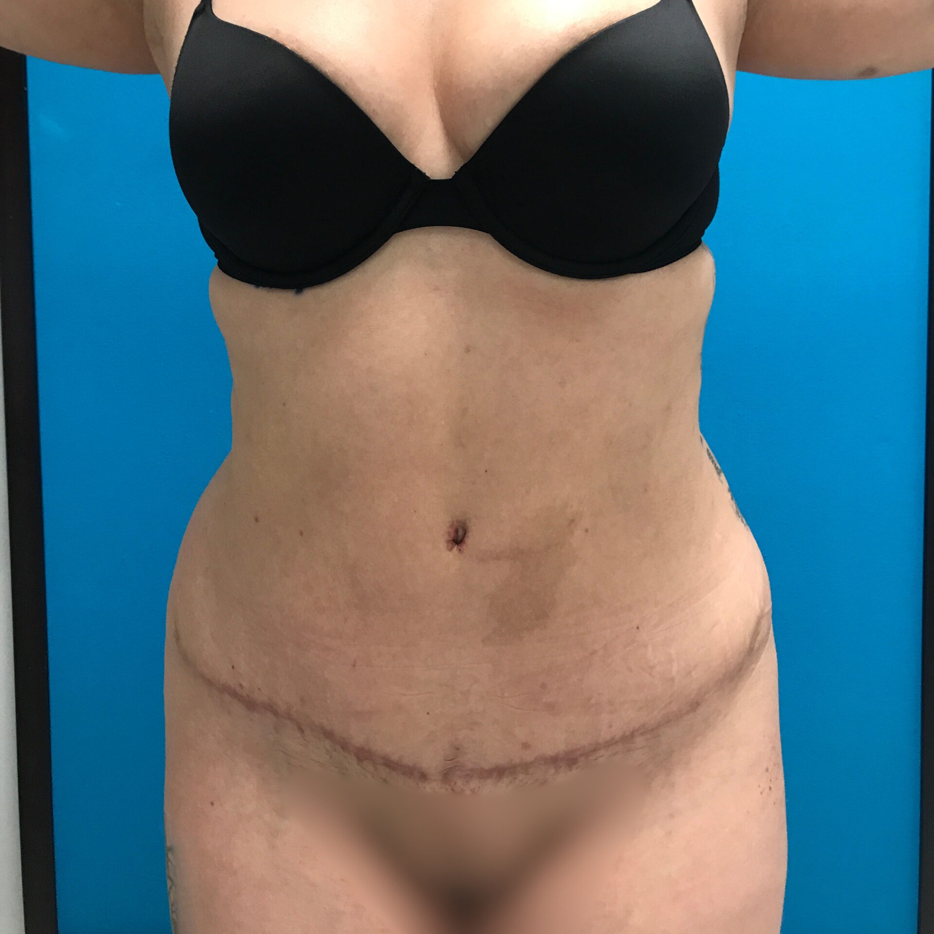 Abdominoplasty-Patient-8 | After Abdominoplasty