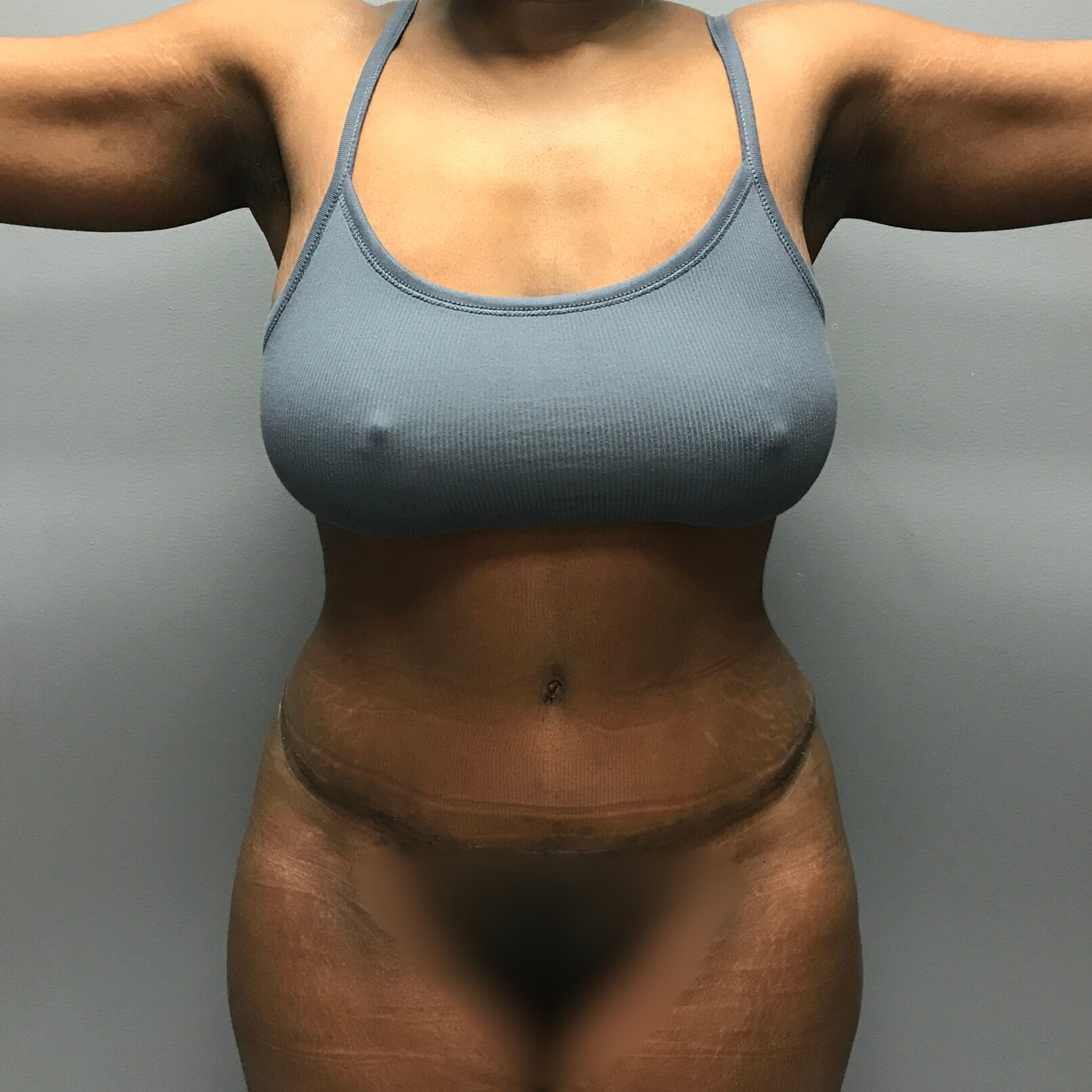 Abdominoplasty-Patient-7 | After Abdominoplasty