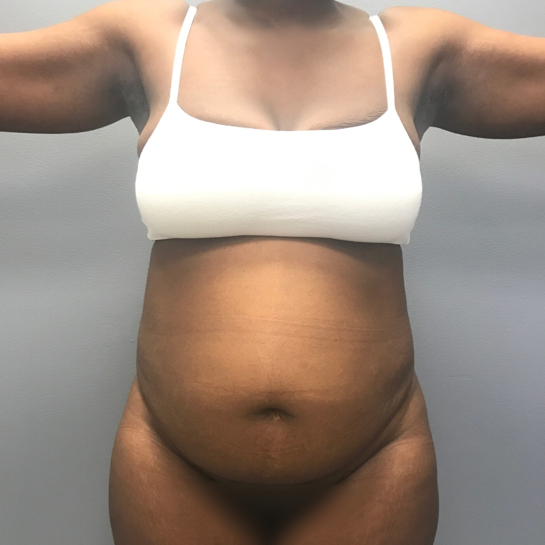 Abdominoplasty-Patient-7 | Before Abdominoplasty