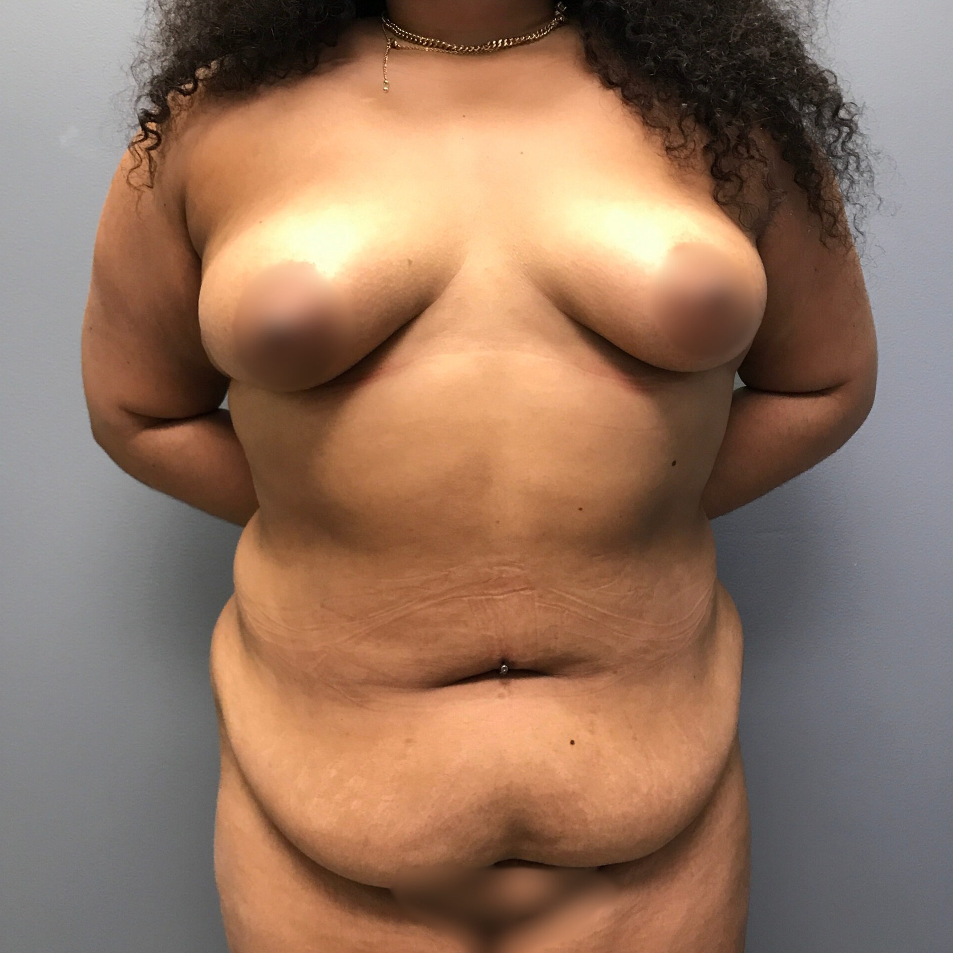 Abdominoplasty-Patient-6 | Before Abdominoplasty